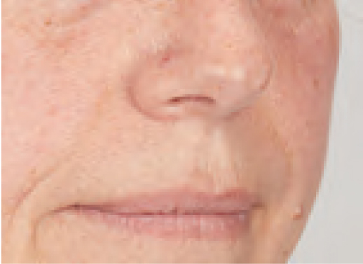 BLEMISHES-I-Redness-of-skin-01-Before Facial Treatment