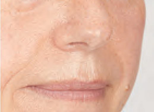 BLEMISHES-I-Redness-of-skin- after Megan Facial Treatment