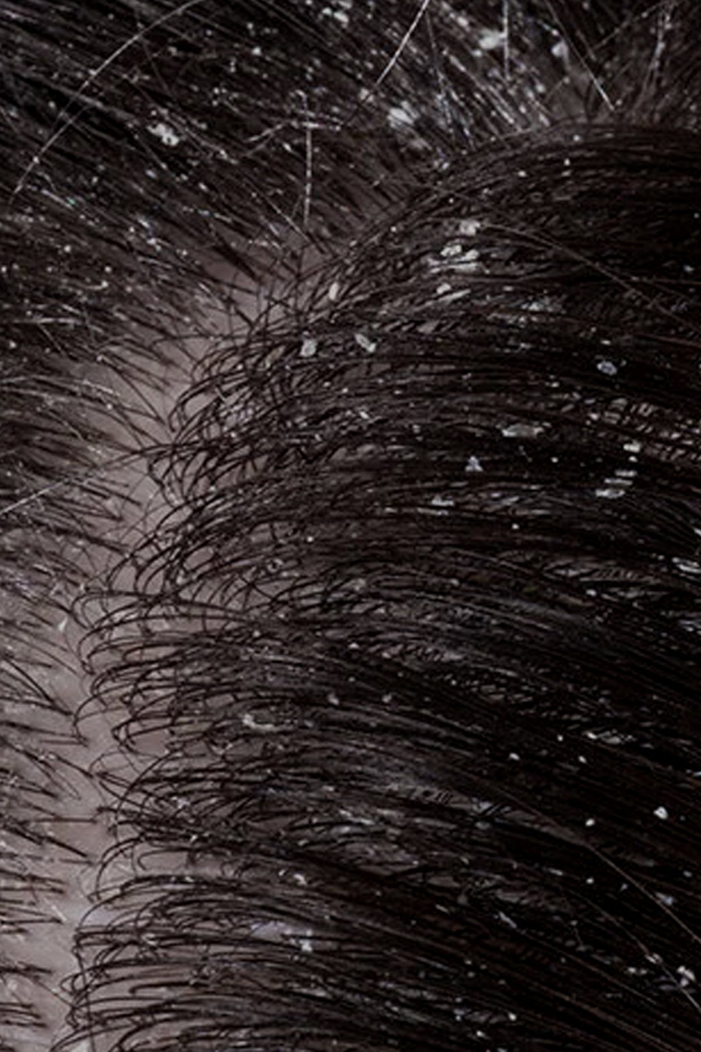 Dandruff_Consultation_Play_Salon_Bangalore